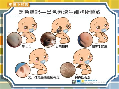 新生兒痣|寶寶胎記形成 八大類型及注意 